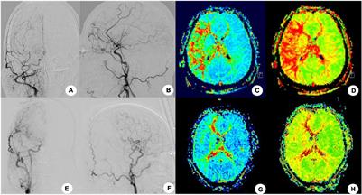 Angiographic Characteristics of Cerebral Perfusion and Hemodynamics of the Bridging Artery After Surgical Treatment of Unilateral Moyamoya Disease